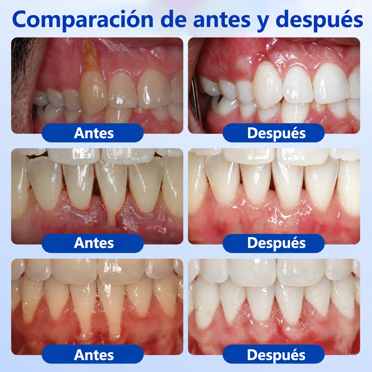 🦷🍧𝑮𝒍𝒊𝒎𝒎𝒆𝒓𝒍𝒚® 𝑮𝒖𝒎𝑹𝒆𝒗𝒊𝒗𝒆 𝑮𝒆𝒍 𝑹𝒆𝒑𝒂𝒓𝒂𝒅𝒐𝒓 𝑷𝒆𝒓𝒊𝒐𝒅𝒐𝒏𝒕𝒂𝒍